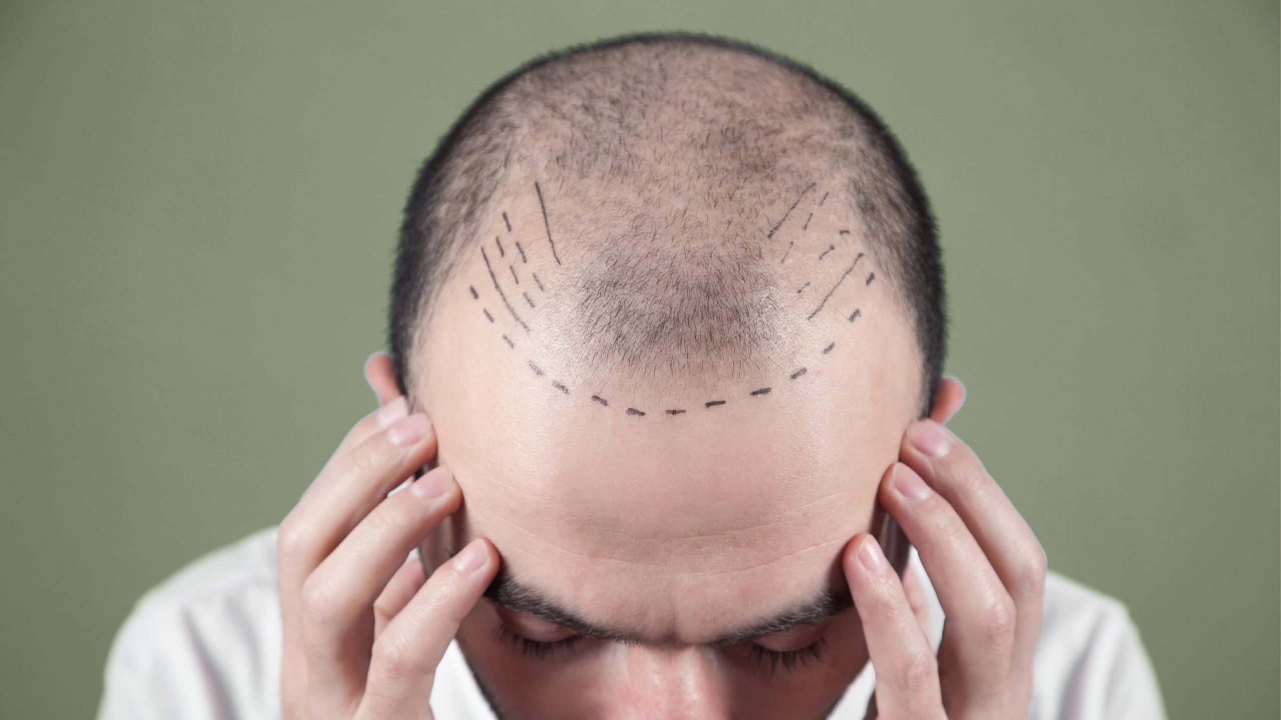 Haartransplantation