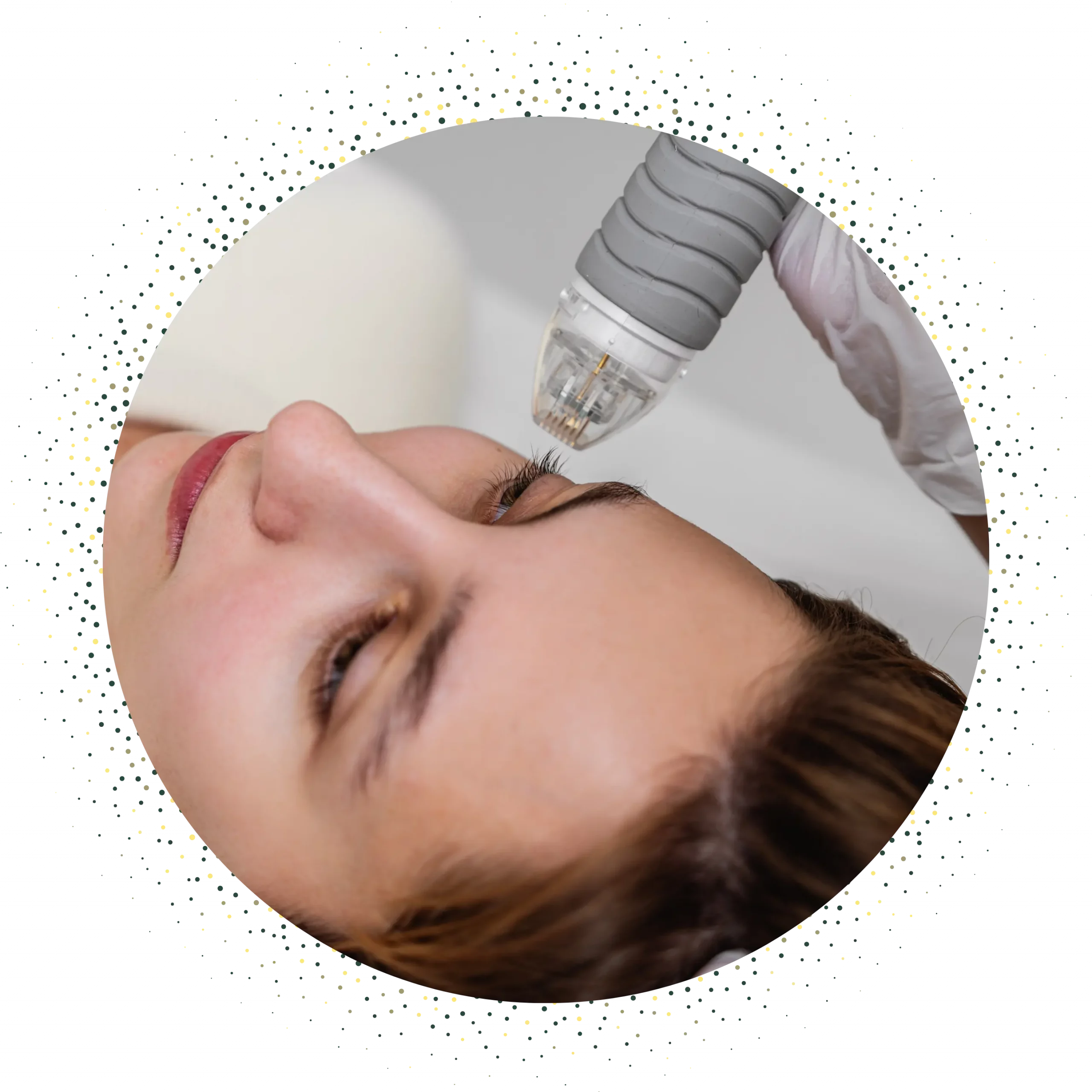 Microneedling zur Hauterneuerungvon Wangen und Kinn